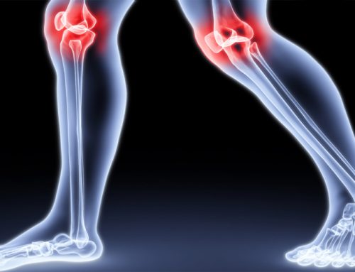 Was tun bei starken Knieschmerzen? Kniearthrose erkennen und behandeln